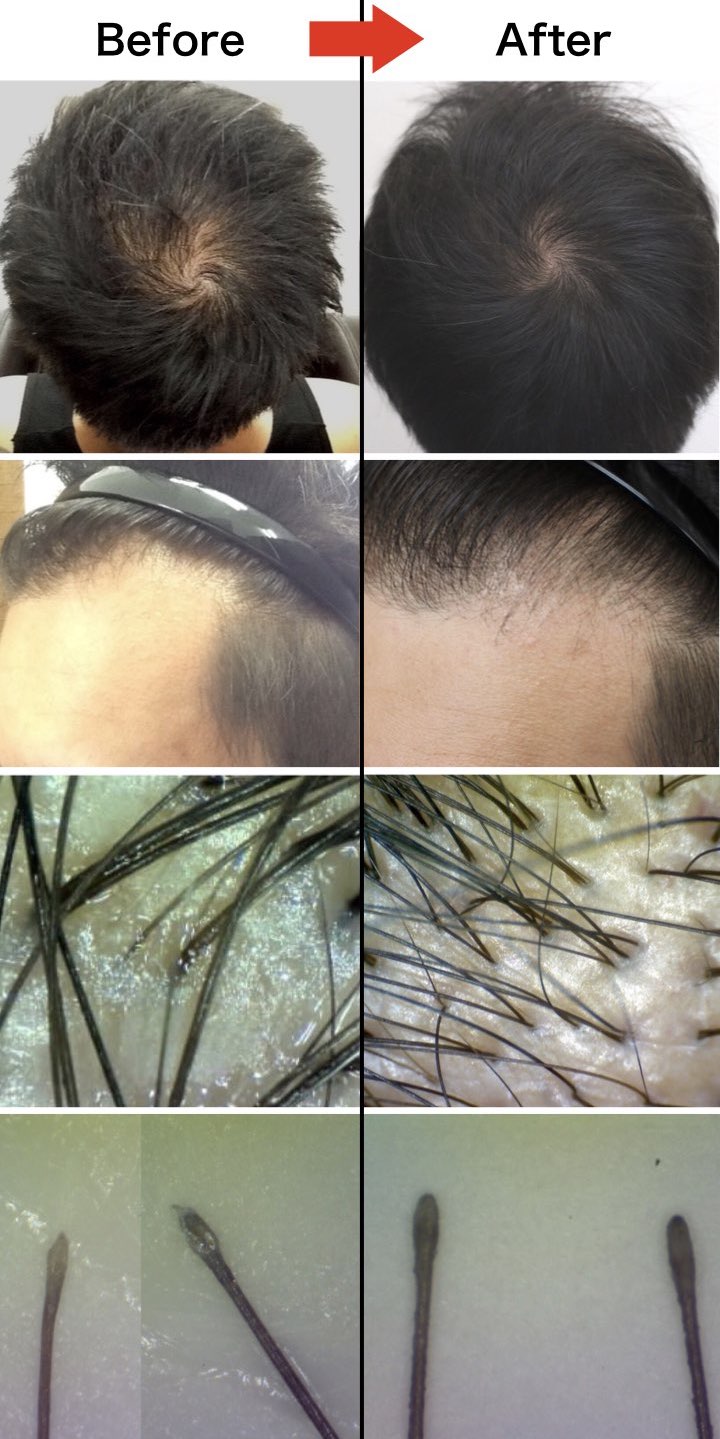 お客様の発毛 頭皮改善の事例と頂いた感想 盛岡市の発毛サロンrise ライズ